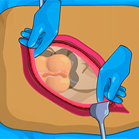 Appendix Surgery